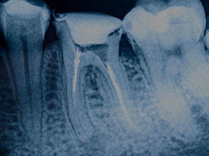 x-ray of a tooth to help with root canal therapy