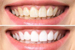 Teeth Whitening Williams Dental